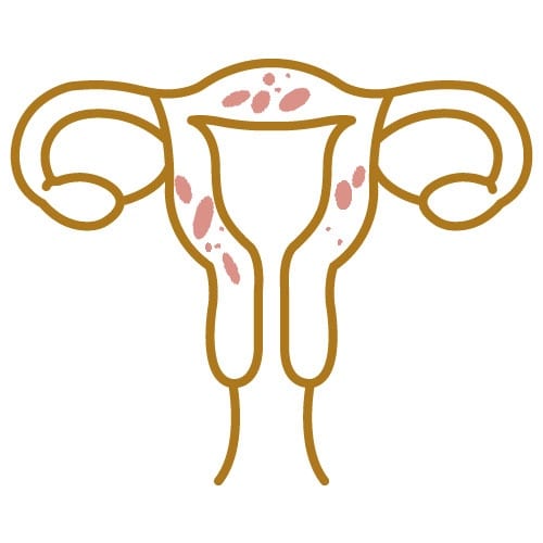 Adenomyosis