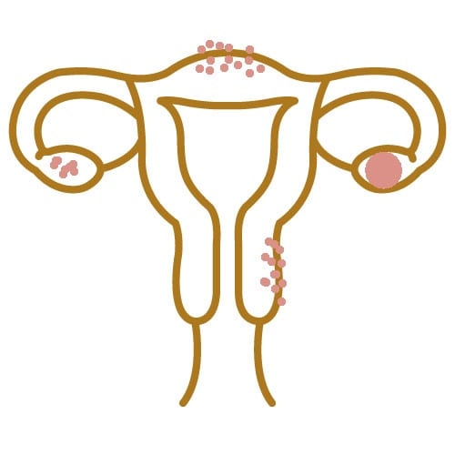 Endometriosis