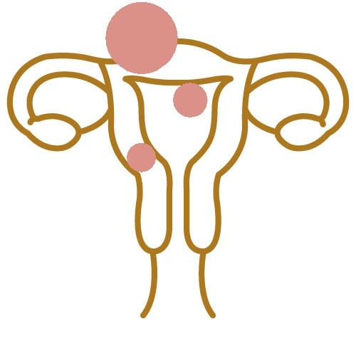 Uterine Fibroids