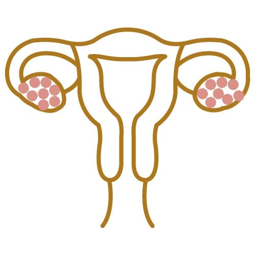 Polycystic ovaries